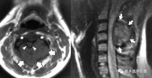 在椎体附件的8种肿瘤,您掌握了吗? 在椎体附件的8种肿瘤,您掌握了吗?