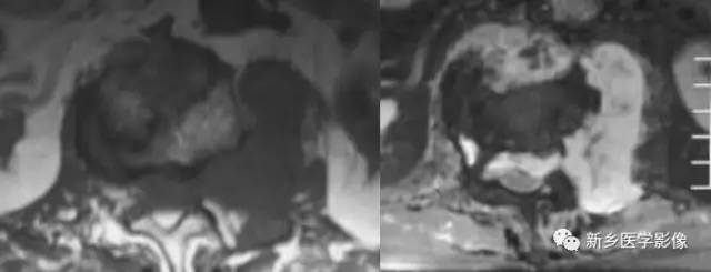 在椎体附件的8种肿瘤,您掌握了吗? 在椎体附件的8种肿瘤,您掌握了吗?