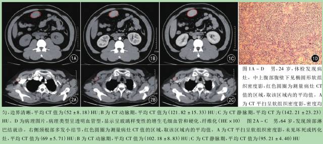 CT增强扫描在鉴别 Castleman病病理类型中价值的研究