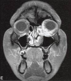 【病例】眼眶内转移瘤1例CT及MR影像表现 【病例】眼眶内转移瘤1例CT及MR影像表现