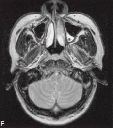【病例】眼眶内转移瘤1例CT及MR影像表现 【病例】眼眶内转移瘤1例CT及MR影像表现