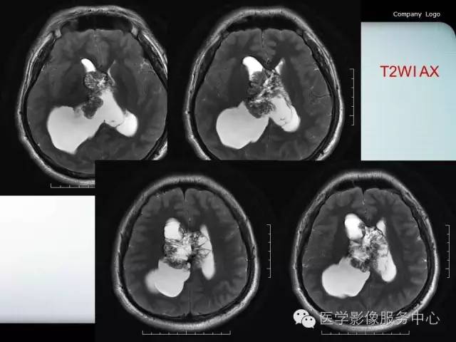 【病例】中枢神经细胞瘤1例MR影像表现