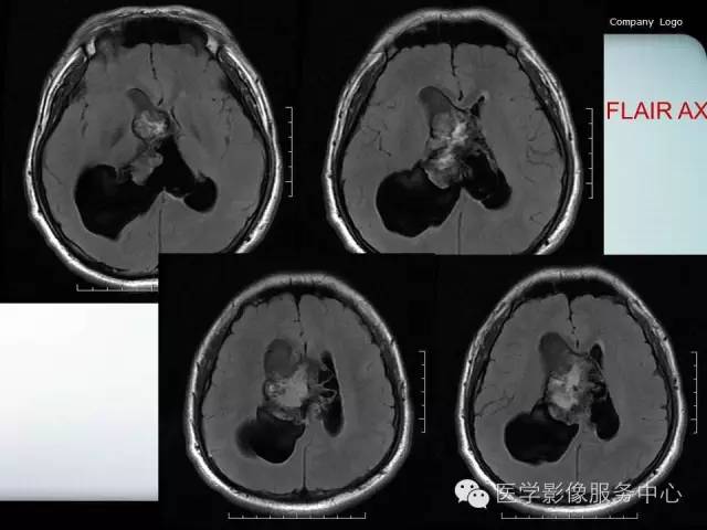 【病例】中枢神经细胞瘤1例MR影像表现
