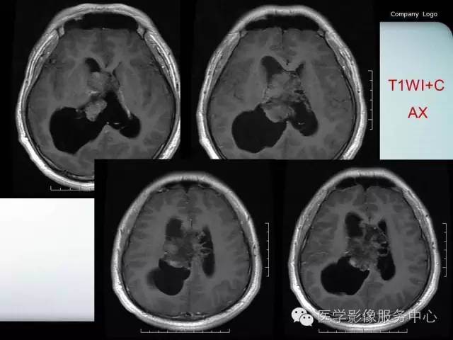 【病例】中枢神经细胞瘤1例MR影像表现