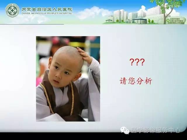 【病例】中枢神经细胞瘤1例MR影像表现