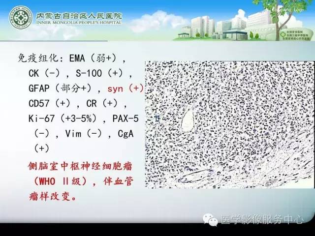 【病例】中枢神经细胞瘤1例MR影像表现