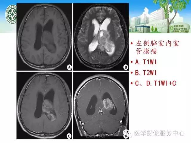 【病例】中枢神经细胞瘤1例MR影像表现