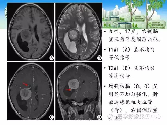 【病例】中枢神经细胞瘤1例MR影像表现
