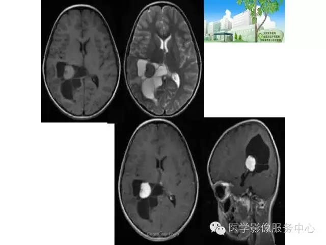 【病例】中枢神经细胞瘤1例MR影像表现