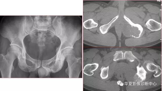 【病例】左侧坐骨软骨肉瘤1例CT及MR影像表现