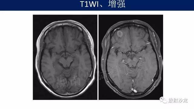 【病例】右额骨骨瘤1例MR影像表现