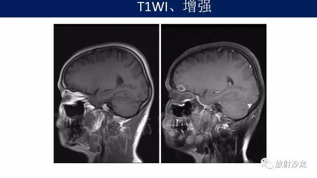 【病例】右额骨骨瘤1例MR影像表现 【病例】右额骨骨瘤1例MR影像表现