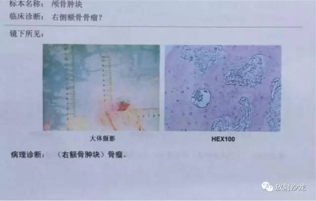 【病例】右额骨骨瘤1例MR影像表现 【病例】右额骨骨瘤1例MR影像表现