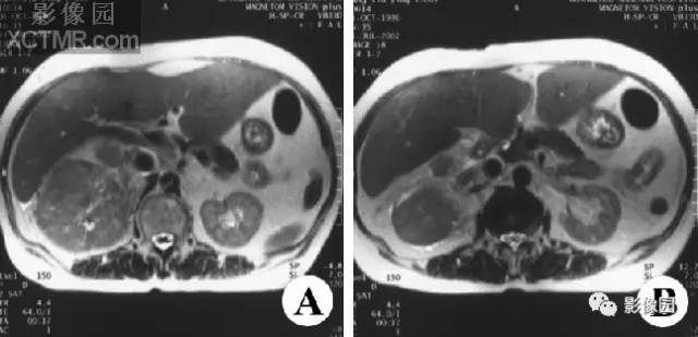 【病例】右肾上腺皮质腺癌1例MR影像表现 【病例】右肾上腺皮质腺癌1例MR影像表现