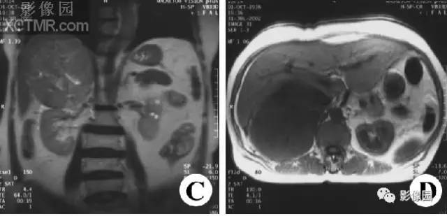 【病例】右肾上腺皮质腺癌1例MR影像表现 【病例】右肾上腺皮质腺癌1例MR影像表现