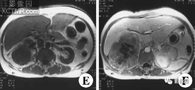 【病例】右肾上腺皮质腺癌1例MR影像表现