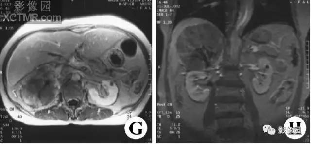 【病例】右肾上腺皮质腺癌1例MR影像表现 【病例】右肾上腺皮质腺癌1例MR影像表现
