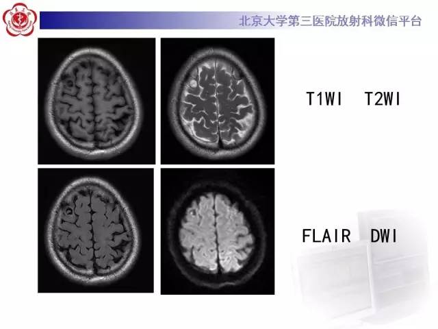 【病例】脑囊虫病1例MR影像表现