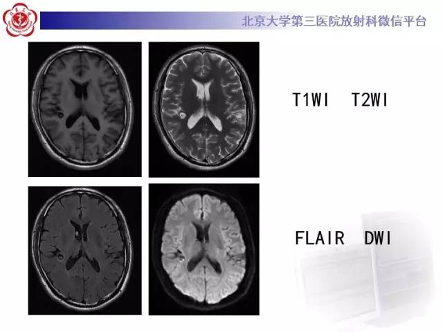 【病例】脑囊虫病1例MR影像表现