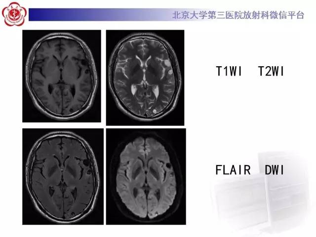 【病例】脑囊虫病1例MR影像表现