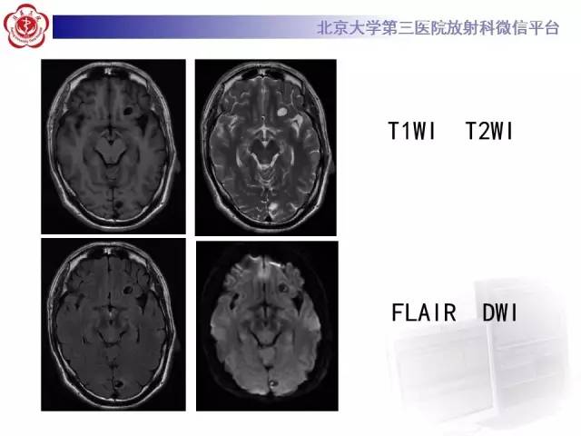 【病例】脑囊虫病1例MR影像表现