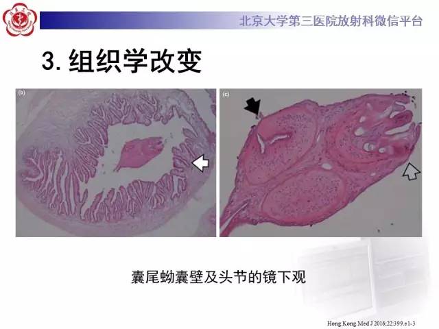 【病例】脑囊虫病1例MR影像表现