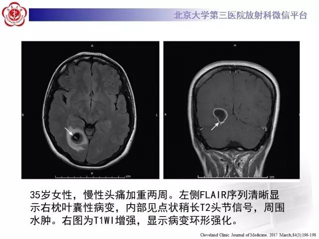 【病例】脑囊虫病1例MR影像表现