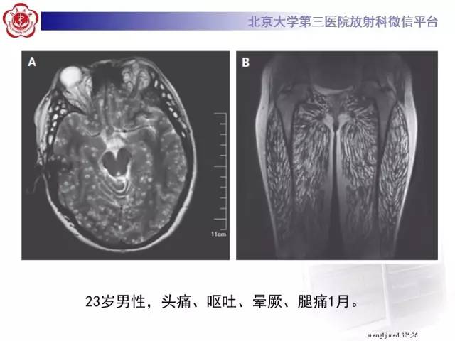 【病例】脑囊虫病1例MR影像表现