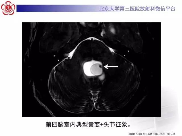 【病例】脑囊虫病1例MR影像表现