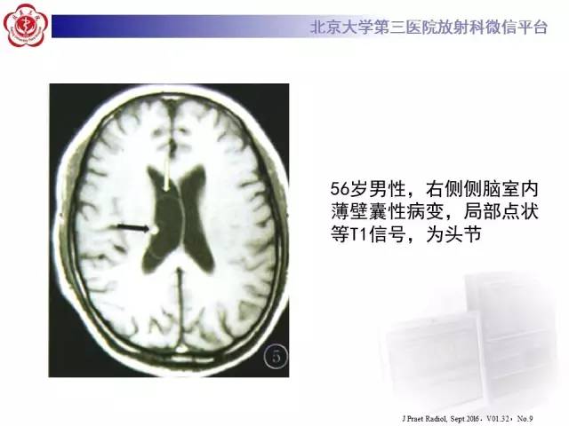 【病例】脑囊虫病1例MR影像表现