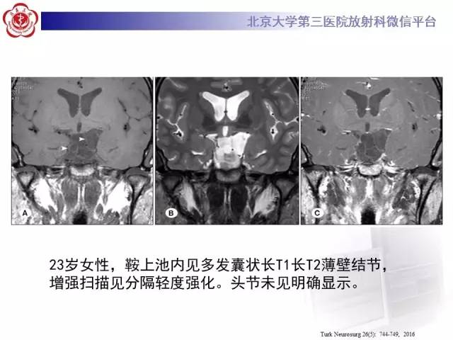 【病例】脑囊虫病1例MR影像表现