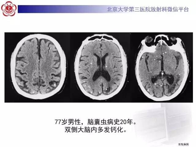 【病例】脑囊虫病1例MR影像表现