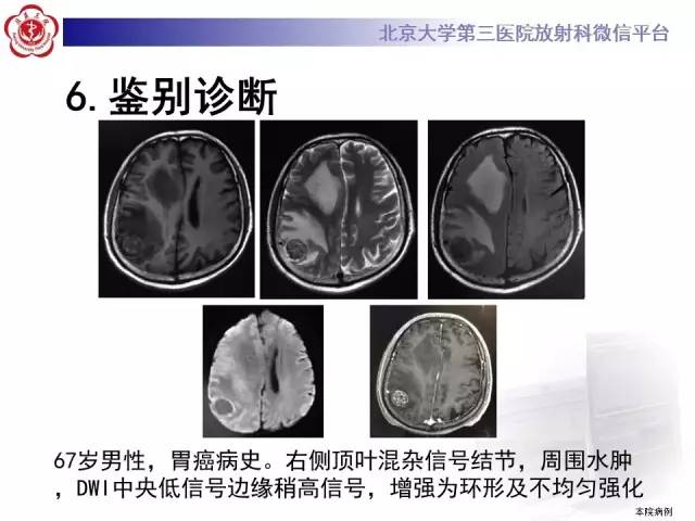 【病例】脑囊虫病1例MR影像表现