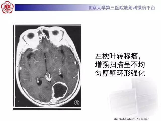 【病例】脑囊虫病1例MR影像表现
