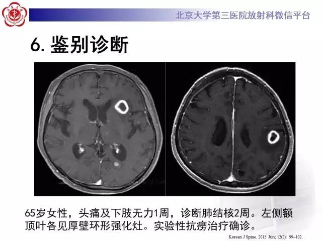 【病例】脑囊虫病1例MR影像表现