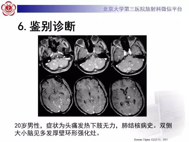 【病例】脑囊虫病1例MR影像表现