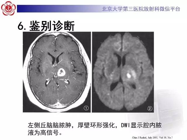 【病例】脑囊虫病1例MR影像表现