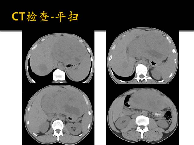 【病例】肝高级别癌肉瘤1例CT影像表现 【病例】肝高级别癌肉瘤1例CT影像表现