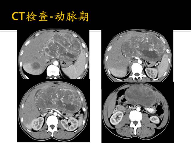 【病例】肝高级别癌肉瘤1例CT影像表现 【病例】肝高级别癌肉瘤1例CT影像表现