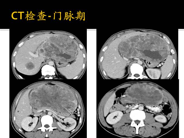 【病例】肝高级别癌肉瘤1例CT影像表现 【病例】肝高级别癌肉瘤1例CT影像表现
