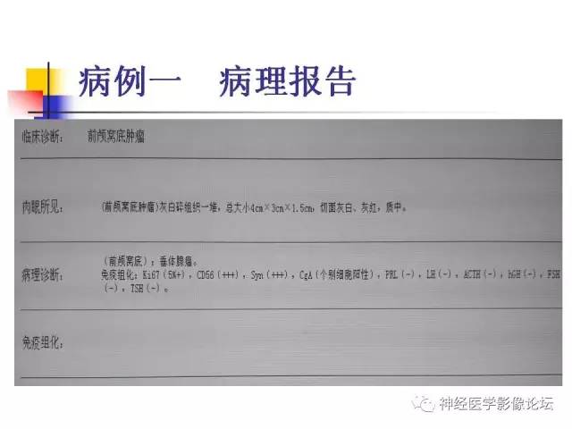 【病例】垂体腺瘤 VS 颅咽管瘤各一例MR