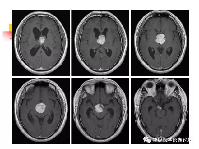 【病例】垂体腺瘤 VS 颅咽管瘤各一例MR