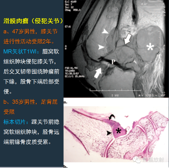 【PPT】滑膜肉瘤影像表现与病理相关性【RG精选】 【PPT】滑膜肉瘤影像表现与病理相关性【RG精选】