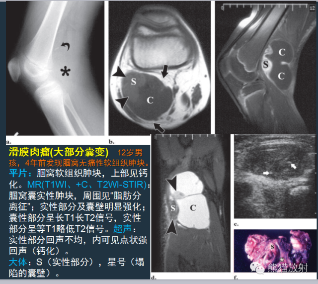 【PPT】滑膜肉瘤影像表现与病理相关性【RG精选】 【PPT】滑膜肉瘤影像表现与病理相关性【RG精选】
