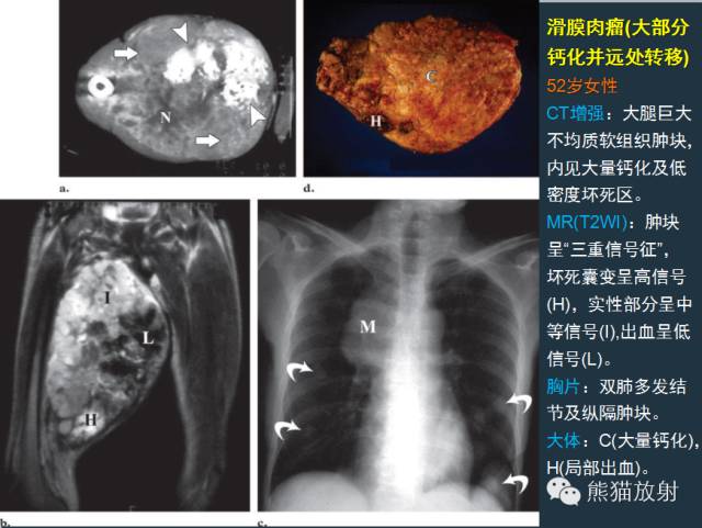 【PPT】滑膜肉瘤影像表现与病理相关性【RG精选】 【PPT】滑膜肉瘤影像表现与病理相关性【RG精选】