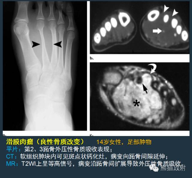 【PPT】滑膜肉瘤影像表现与病理相关性【RG精选】 【PPT】滑膜肉瘤影像表现与病理相关性【RG精选】
