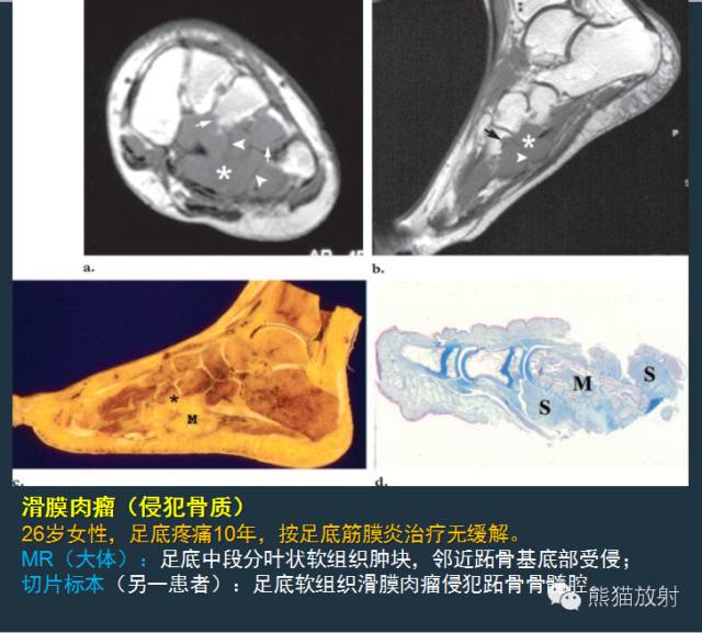 【PPT】滑膜肉瘤影像表现与病理相关性【RG精选】 【PPT】滑膜肉瘤影像表现与病理相关性【RG精选】