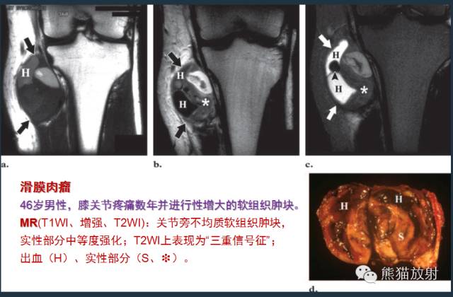 【PPT】滑膜肉瘤影像表现与病理相关性【RG精选】 【PPT】滑膜肉瘤影像表现与病理相关性【RG精选】