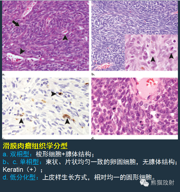 【PPT】滑膜肉瘤影像表现与病理相关性【RG精选】 【PPT】滑膜肉瘤影像表现与病理相关性【RG精选】