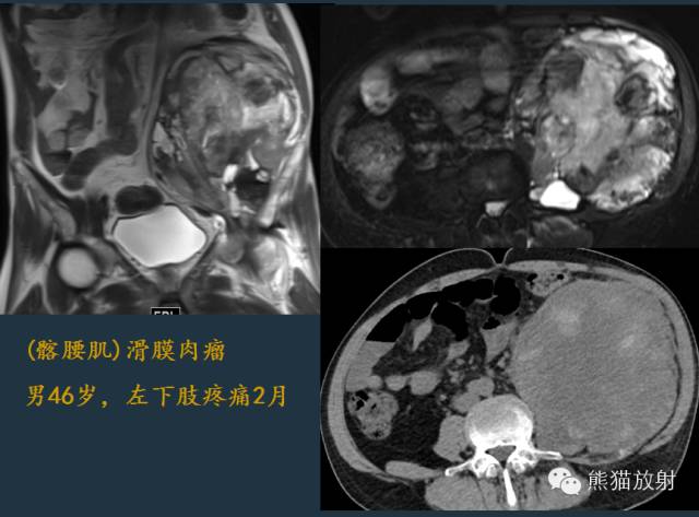 【PPT】滑膜肉瘤影像表现与病理相关性【RG精选】 【PPT】滑膜肉瘤影像表现与病理相关性【RG精选】